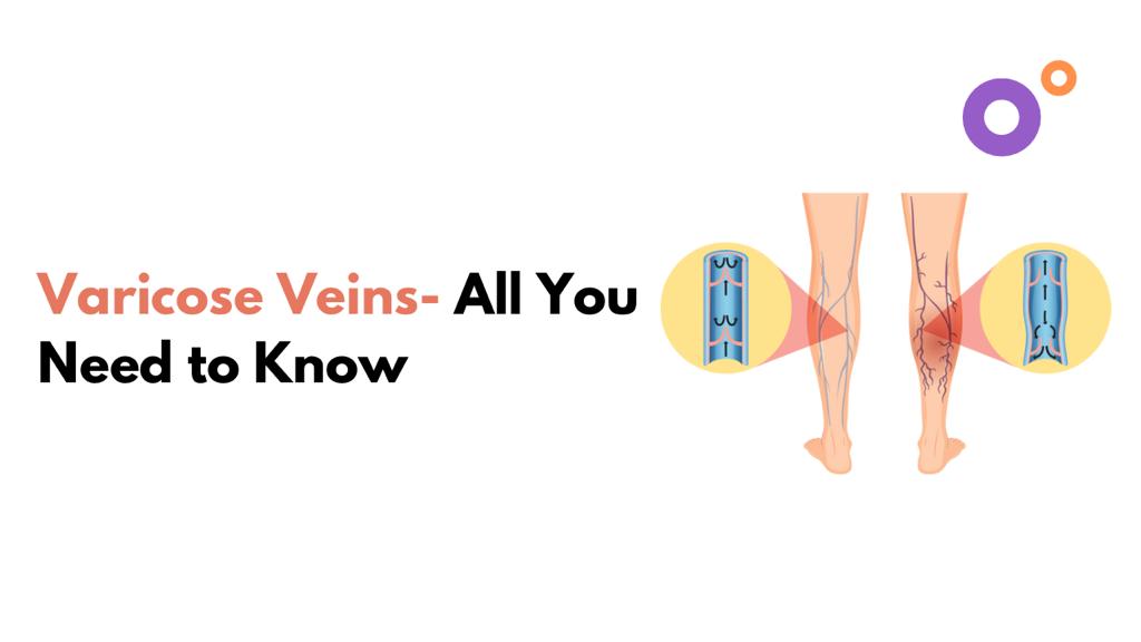 Varicose Veins - All You Need to Know