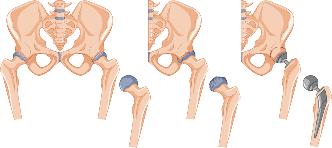 hip replacement Surgery By Firstcure Health